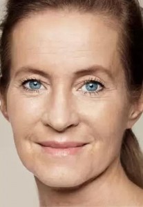 Restylane Full Face After 
